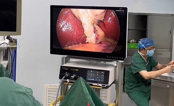 4K腹腔镜系统在胆囊切除术中的优势